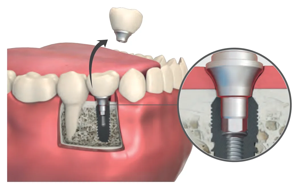 A fractured abutment in the jaw: its upper part is lifted off the implant, with a detail of the remaining fragment