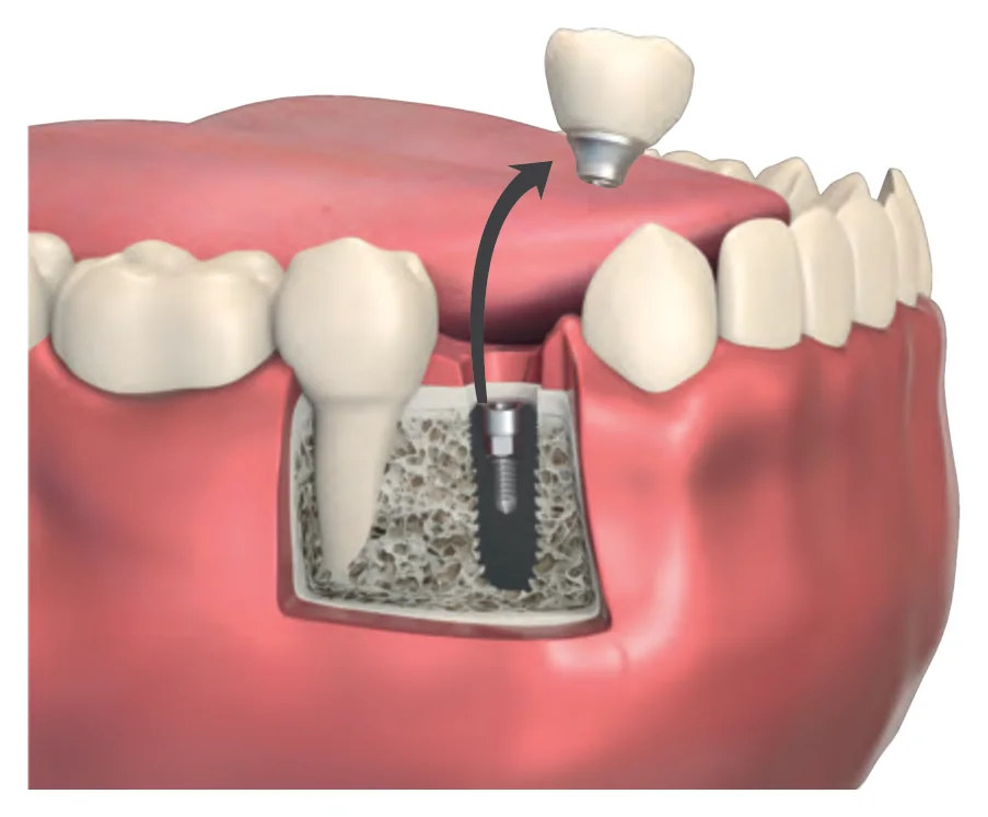 Removing the upper part of the broken abutment from the implant before using the removal part