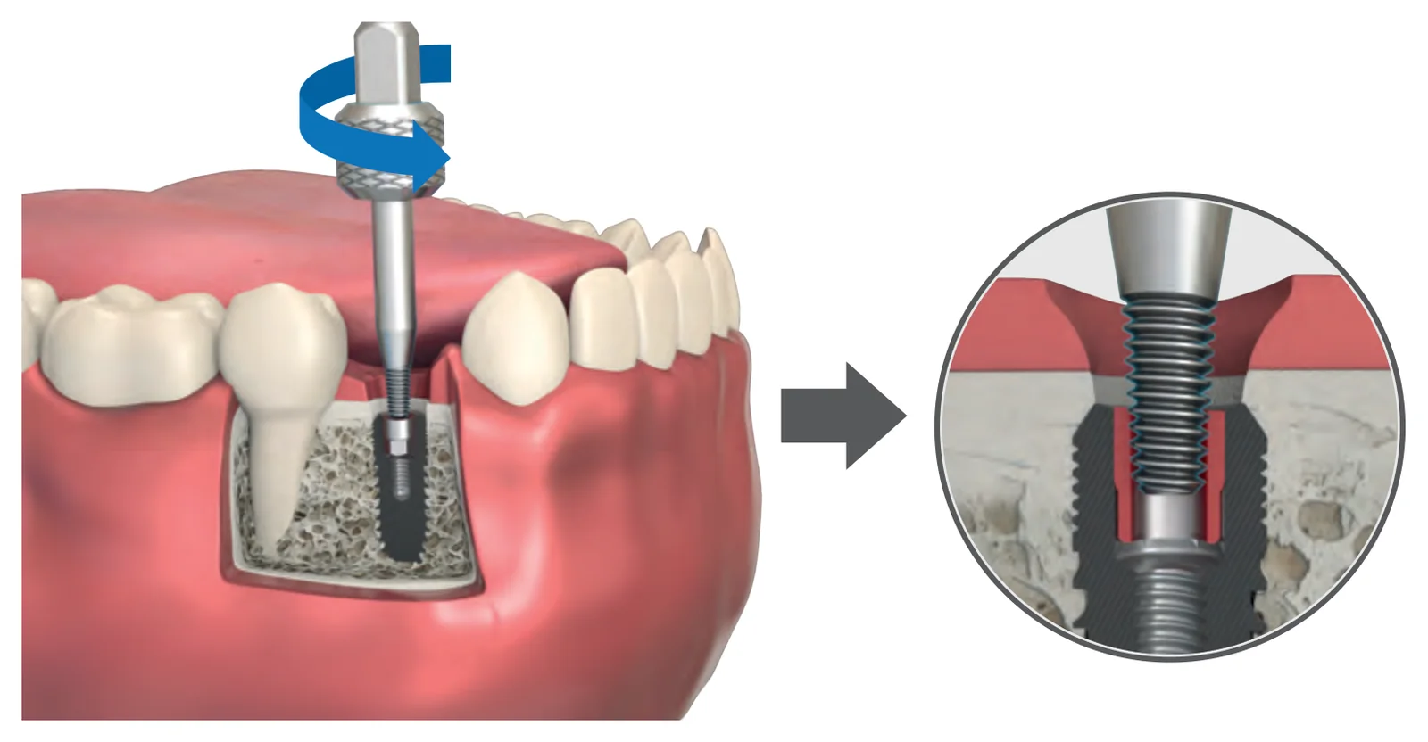Pressing the broken abutment removal part against the fragment in the implant and rotating it counterclockwise, with a detail of the thread