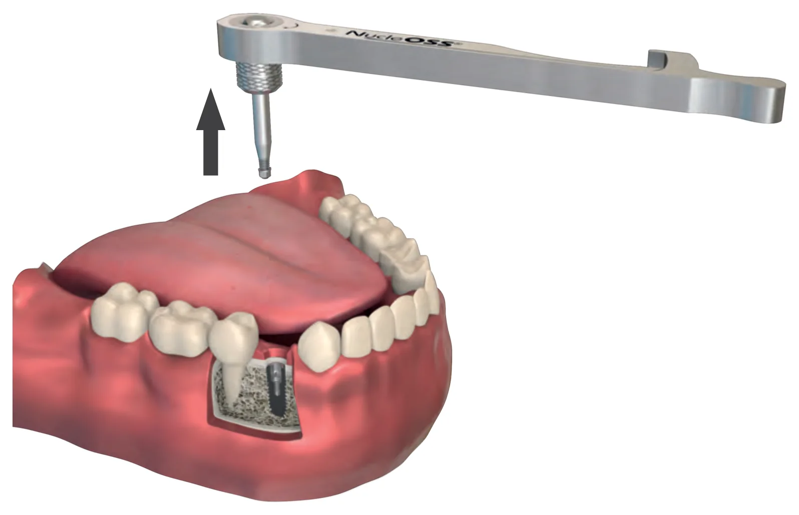 The abutment removal piece lifted out of the implant with the fractured portion