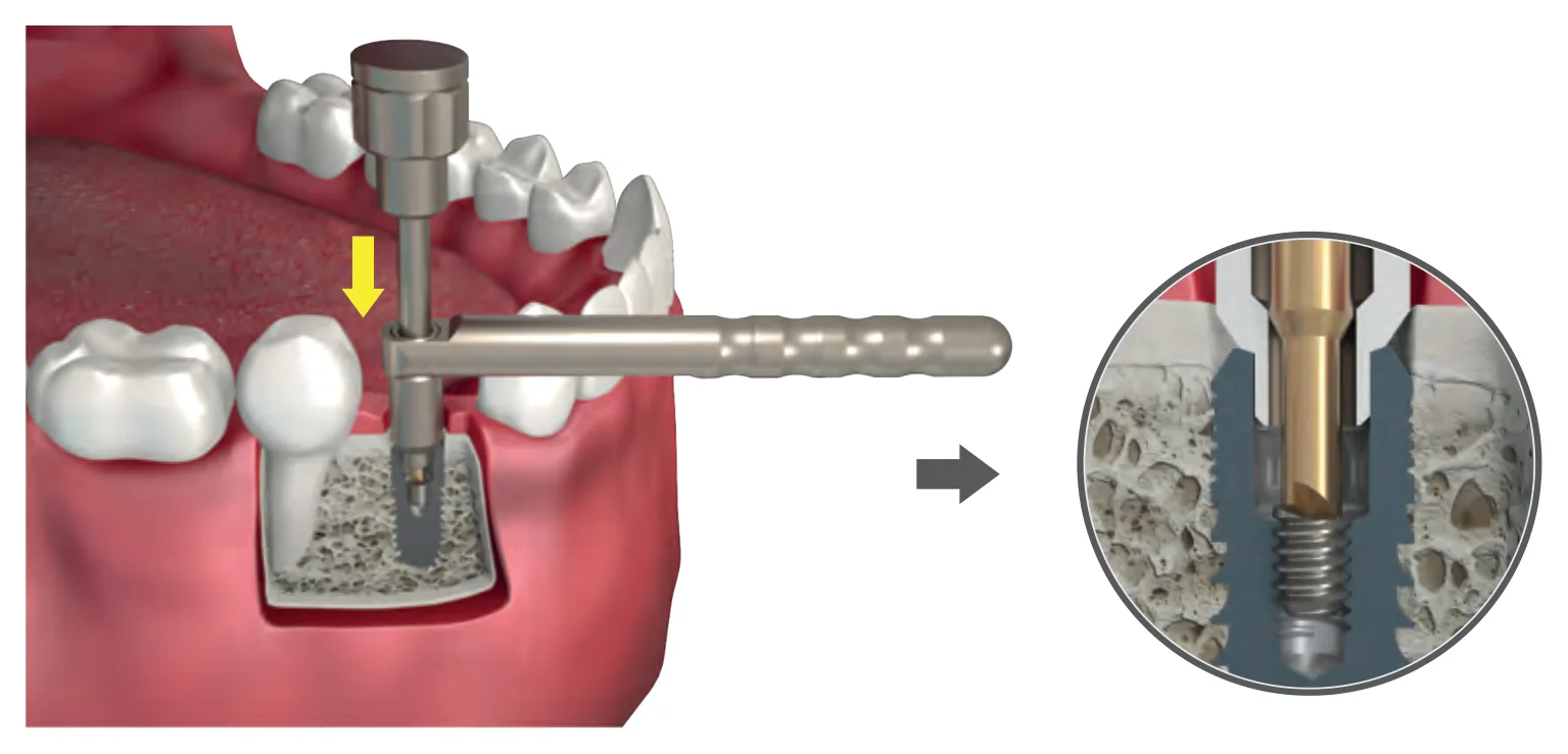 Method 1: the drill passed through the centering device and pressed onto the broken screw, with a detail of the drill tips embedded in the screw surface