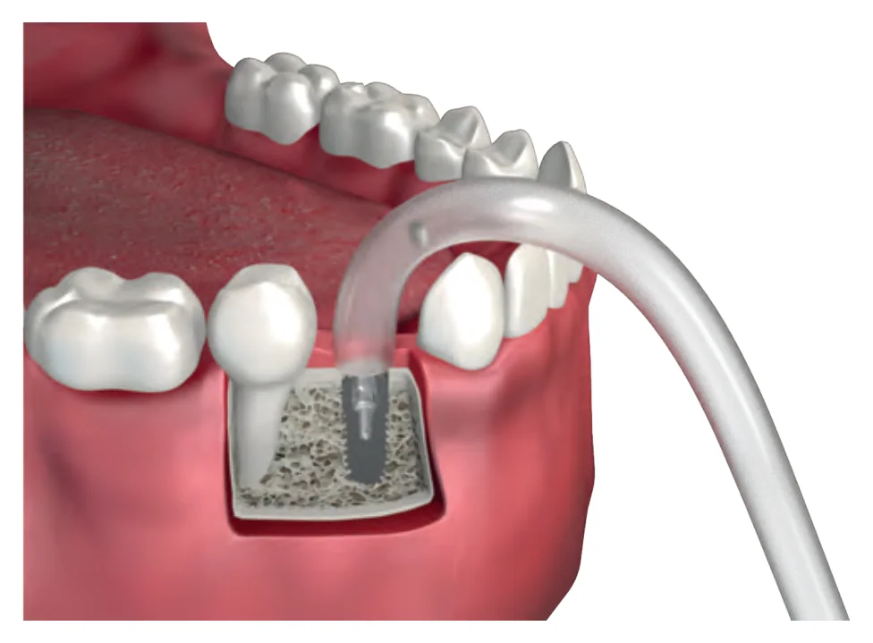 Method 1: removing the broken screw from the implant with vacuum and water