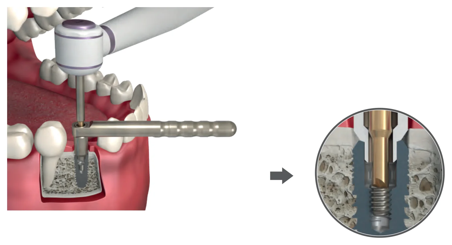 Method 2: the drill in the micromotor passed through the centering device and pressed onto the broken screw, with a detail of the drill tips
