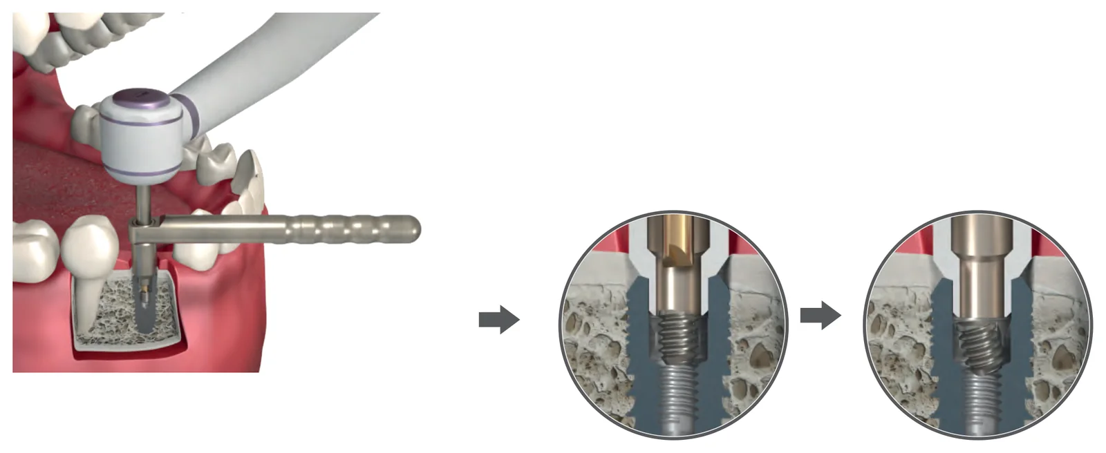 Method 2: removal with the micromotor turning counterclockwise, with details of the screw coming loose