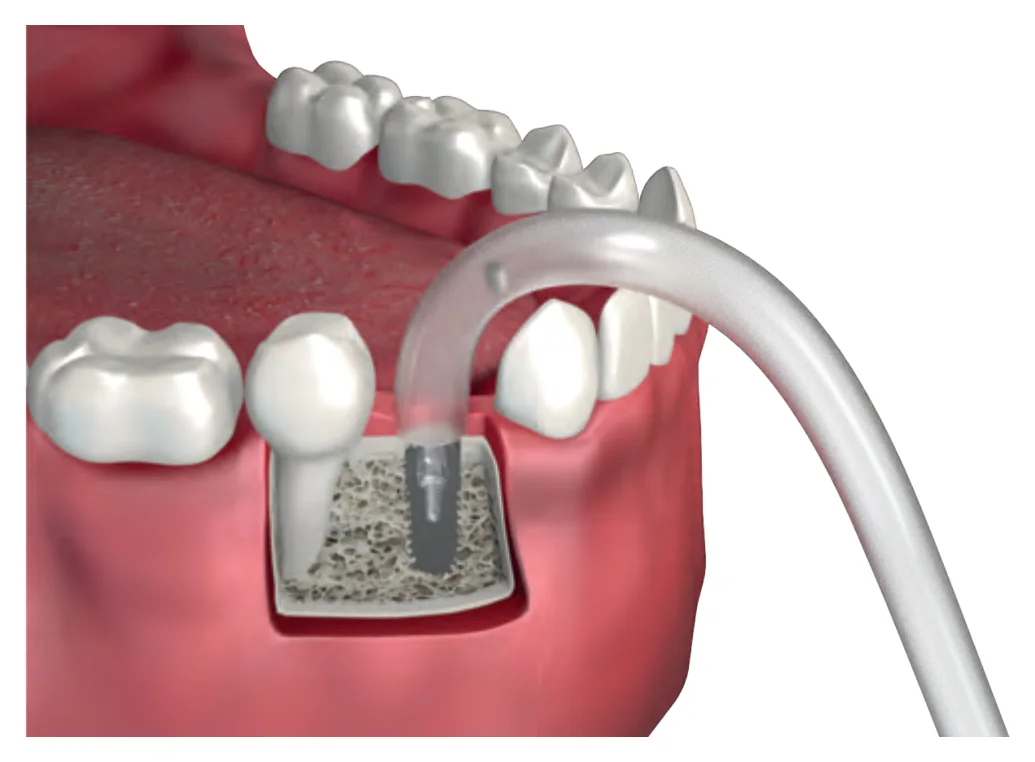 Method 2: removing the broken screw from the implant with vacuum and water
