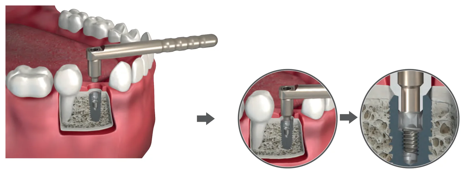 Cleaning the implant with water, vacuum and air, then carefully placing the centering device over the implant