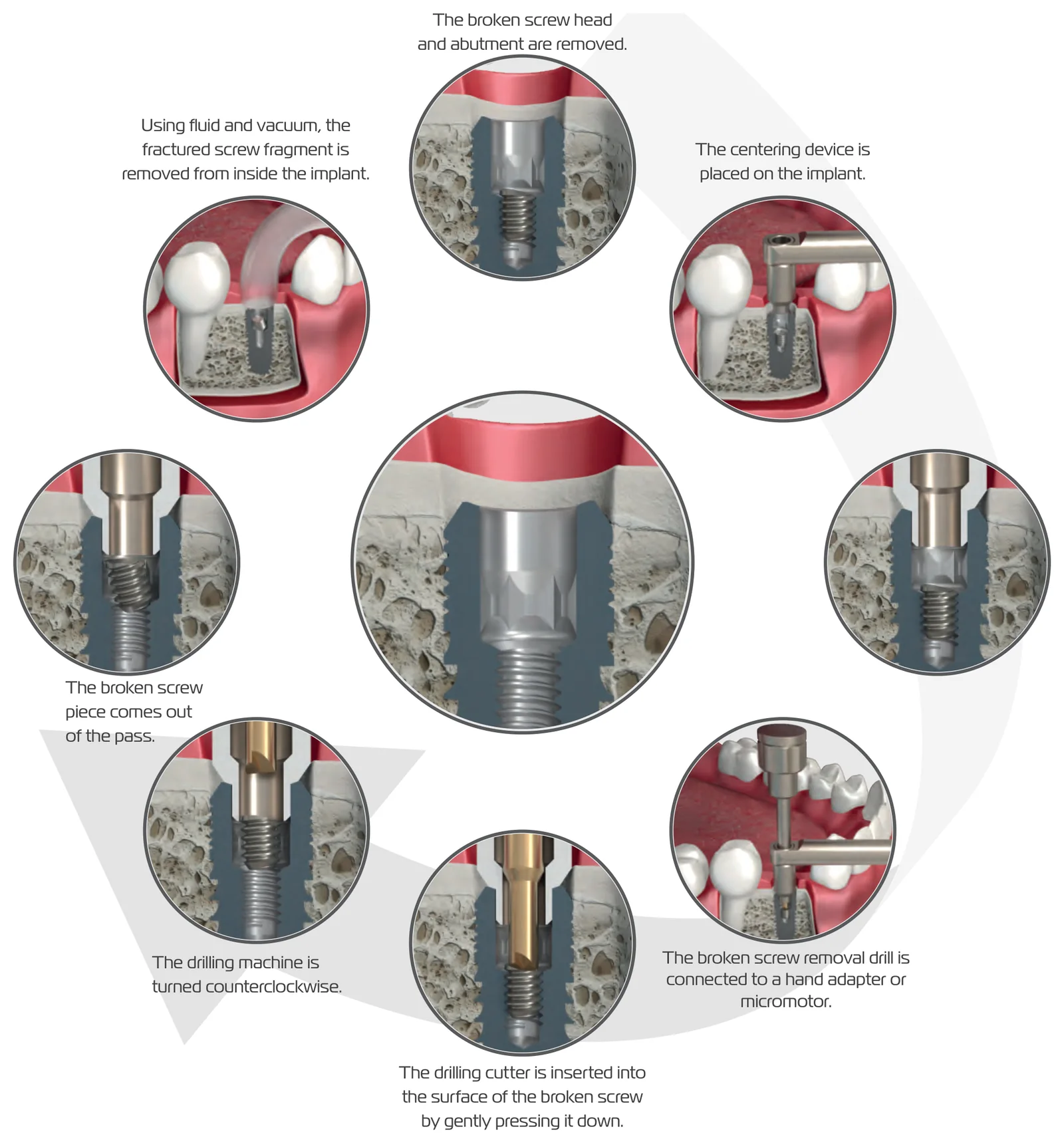 General work flow in seven steps: broken screw head and abutment removed, centering device placed, drill connected to a hand adapter or micromotor, cutter pressed into the screw, drill turned counterclockwise, screw piece comes out, fragment removed with fluid and vacuum