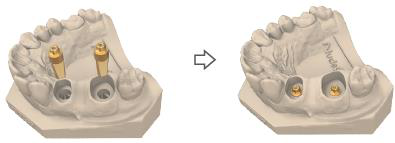 Multi unit digital analogues placed into the printed 3D dental model, shown before and after seating.