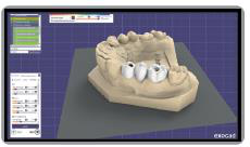 Exocad software screenshot of the designed bridge teeth shown on the patient's 3D dental model.