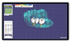 Exocad software screenshot of the bridge prosthesis designed over the two multi unit Ti-base abutments on the jaw model.