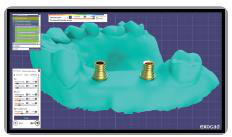 Exocad software screenshot of the 3D jaw model with two gold-coloured multi unit Ti-base abutments in place, before the bridge is designed.