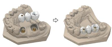 Bridge on the 3D dental model with occlusal screws placed, then the model with the bridge seated.