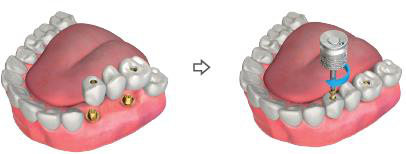 Multi-unit abutments in the patient's mouth, then the bridge placed on them with an occlusal screw turned by a manual hex driver.