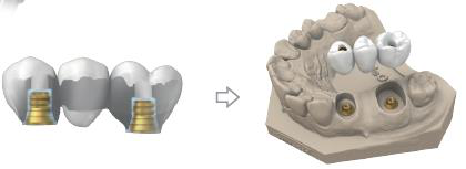 Bridge prosthesis with cemented multi unit tibase abutments, then placed on the multi unit analogues in the 3D dental model.