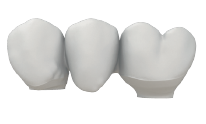 Three-unit bridge prosthesis shown on its own.