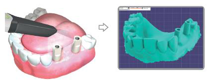 An intraoral scanner held over scan posts on the patient's lower arch, followed by the resulting 3D dental model shown on screen.