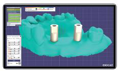 Screenshot of dental design software (exocad) showing the 3D jaw model with two multi unit Ti-base abutments selected from the library.