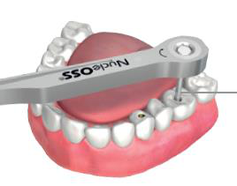 A torque ratchet marked NucleOSS tightening the occlusal screw on the bridge in the patient's mouth.