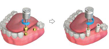 Two views of a scan post placed on a multi unit abutment in the patient's mouth and turned with a hex driver, before and after a second scan post is added.