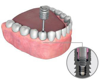 Lower jaw model with a manual hex wrench turning the connection screw of an abutment, with an enlarged cut-away view of the screw in the implant.