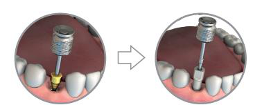 Two views of a scan part connected to the implant in the patient's mouth with a Hex wrench, before and after the part is seated.