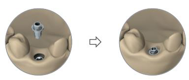 Two views of a plaster model: a Ti-base abutment held above the standard analogue, then the Ti-base abutment seated on the analogue.