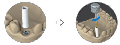 Plaster model with a white casting cap on the Ti-base support, then the long connection screw being tightened with a manual hex wrench (curved arrow shows the turn).