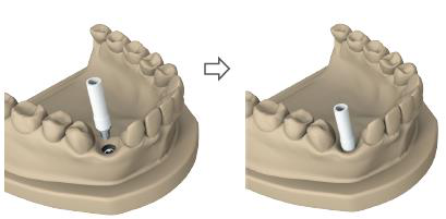 Plaster model with the white casting cap on the CoCr cast abutment, shown before and after it is seated on the standard analogue.