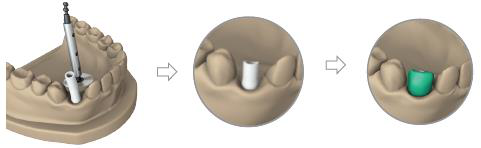 Plaster model with the casting cap on the support and a screwdriver in the screw channel, then the cap cut back beside the neighbouring teeth, then a green wax model built on the cut casting cap.