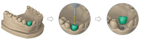 Plaster model with the green wax model and a screwdriver in the screw channel, the screw being removed, then the wax model lifted off leaving the analogue.