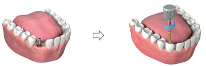 Lower jaw model with the abutment placed on the implant in the mouth, then a manual hex wrench tightening the abutment screw by hand (curved arrow shows the turn).