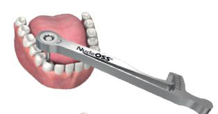 NucleOSS torque rack (ratchet wrench, marked NucleOSS) on the abutment screw in a lower jaw model.
