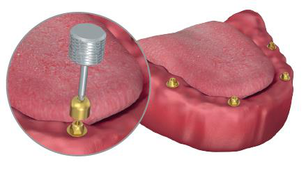 Left: a manual hex key lifting a comfort cap from one multi-unit abutment, shown enlarged in a circle. Right: the lower jaw with the multi-unit abutments in place and the comfort caps removed.