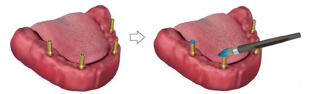 Temporary titanium caps placed on the multi-unit abutments in the lower jaw, then an arrow to the same jaw with a marker pen marking the caps.