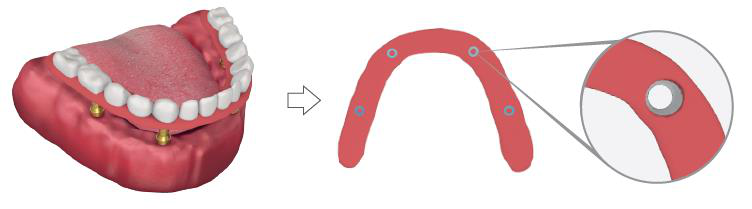 The lower jaw with the marked temporary titanium caps, an arrow to the acrylic denture shown as a flat arch with holes at the marked positions, and an enlarged circle showing one hole.