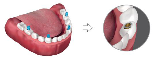 The acrylic denture with holes placed over the temporary titanium caps in the lower jaw, and an enlarged circle showing a cap protruding through the prosthesis at the marked and cut position.