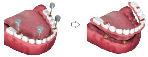 Left: the lower jaw with the prosthesis seated and occlusal screws being tightened on the caps with a hex key. Right: the prosthesis lifted from the abutments after the liquid acrylic has set.