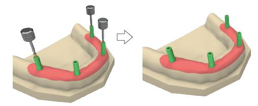 Plaster model of the lower jaw with green burn-out caps on the multi-unit analogues and occlusal screws being inserted with a hex key, then an arrow to the model with all caps fixed.