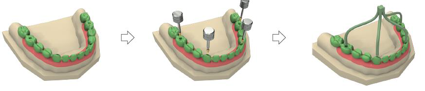 Three plaster-model views in sequence: the wax teeth model over the burn-out caps, the occlusal screws being removed, and the wax model with wax channels attached to form a casting path.