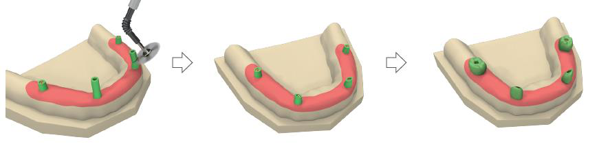 Three plaster-model views in sequence: a cutting bur trimming the burn-out caps, the cut caps, and the caps with the wax prosthesis teeth model built over them.