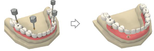Left: the metal dental prosthesis on the analogues in the plaster model with occlusal screws and hex keys. Right: the finished prosthesis on the model with teeth.