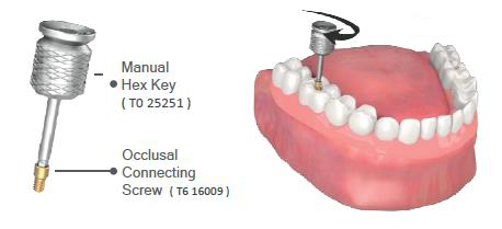 Left: a manual hex key labelled "Manual Hex Key ( T0 25251 )" and an occlusal connecting screw labelled "Occlusal Connecting Screw ( T6 16009 )". Right: a hex key turning an occlusal screw in the total prosthesis in the lower jaw.