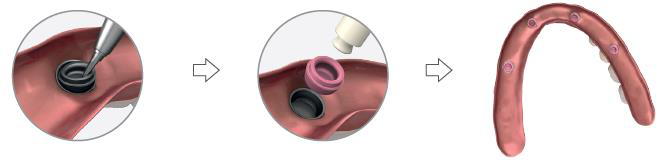 Three-step picture: a close-up of a tool removing the black silicone from a metal slot, an arrow, a close-up of pink silicone being placed in the slot, an arrow, then the finished prosthesis.