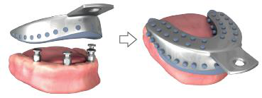 Two-step picture: a perforated metal impression tray held above a lower jaw model with four implant posts, an arrow, then the tray seated over the jaw.
