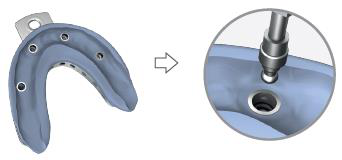 Two-step picture: the set impression tray with several holes, an arrow, then a close-up circle showing an instrument at one of the holes.