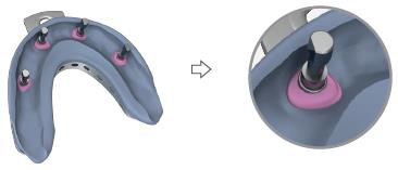 Two-step picture: an impression tray with analogs in place and pink gum silicone around them, an arrow, then a close-up circle of one analog with pink silicone around its base.