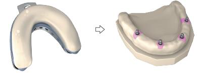 Two-step picture: an impression tray filled with plaster, an arrow, then the finished plaster model with analogs and pink gum silicone.