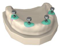 Plaster jaw model with metal mounts on the analogs, each surrounded by green mask material.