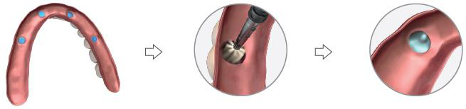 Three-step picture: a prosthesis with blue marked spots, an arrow, a close-up of a tool opening one marked area, an arrow, then a close-up of a blue metal ring seated in the opened slot.