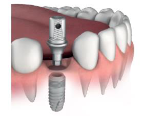 Illustration of a straight abutment with a screw hole, shown above a dental implant, in a lower jaw model with neighbouring teeth.